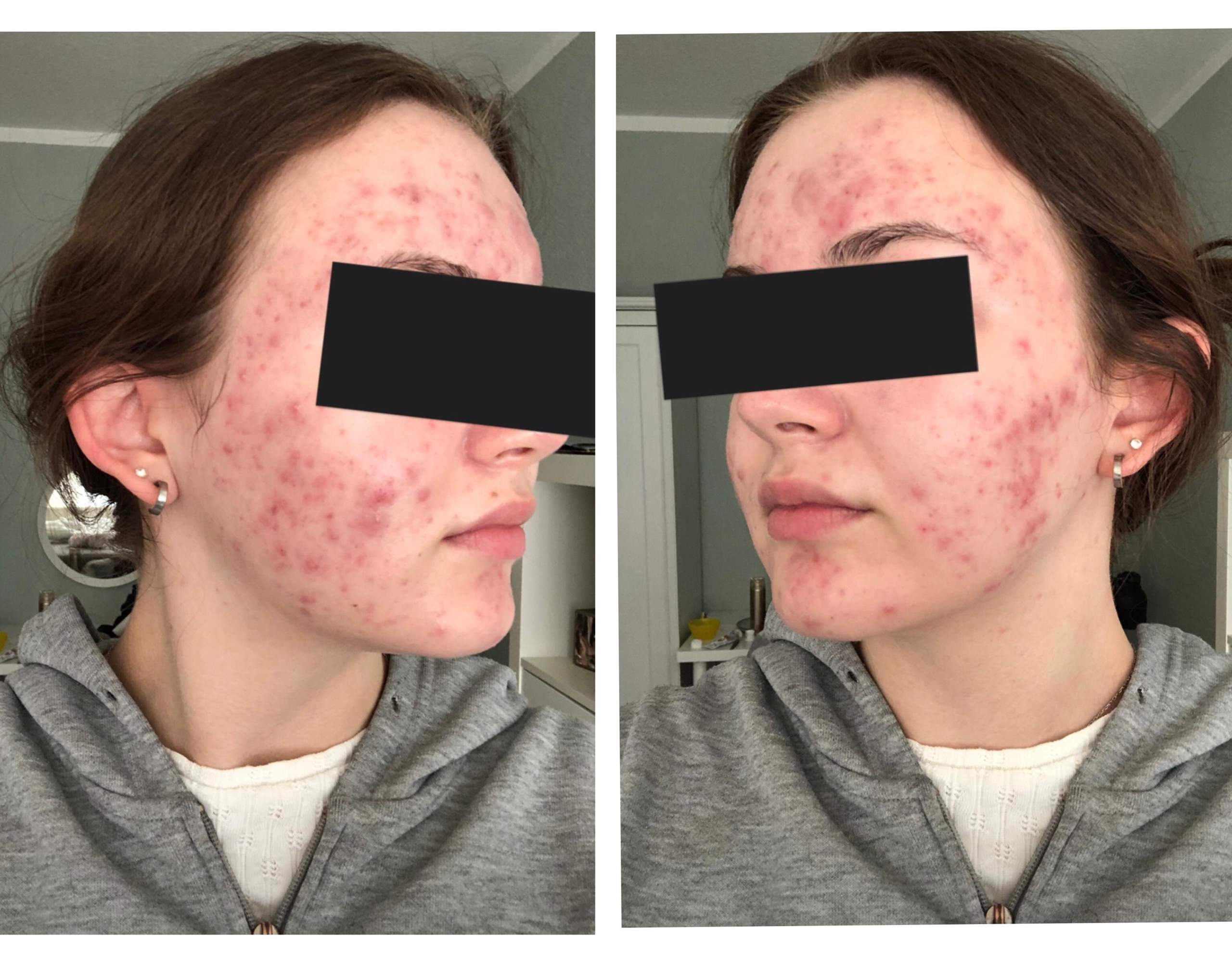 Isotretinoin pickel tabletten