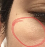 Erhebung Unterm Auge Haut Augen Erhebung Unterm Auge Haut Augen