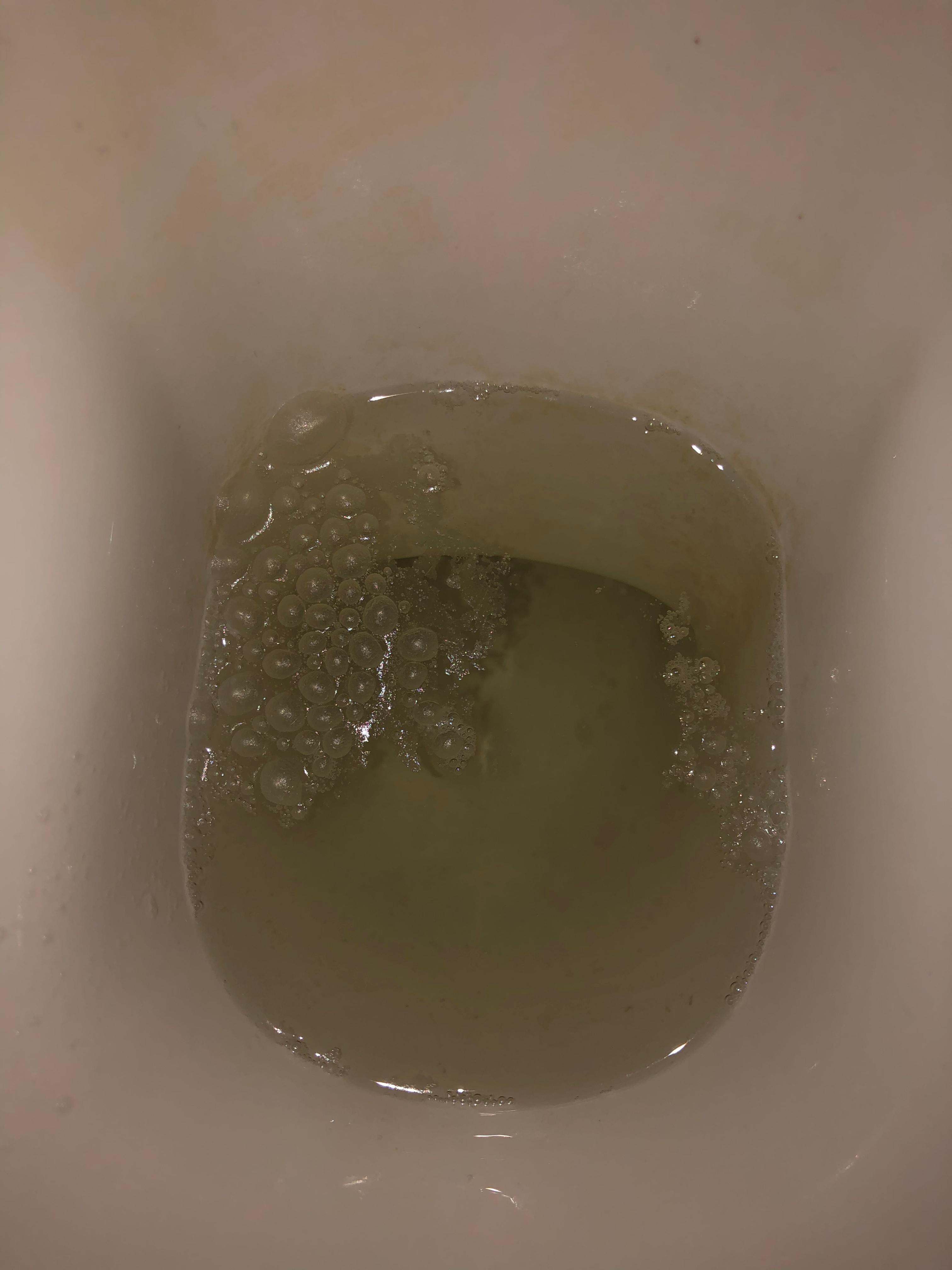 Erhohter Eiweiss Im Urin Gesundheit Und Medizin Nieren Harnwegsinfekt Erhohter Eiweiss Im Urin Gesundheit Und Medizin Nieren Harnwegsinfekt