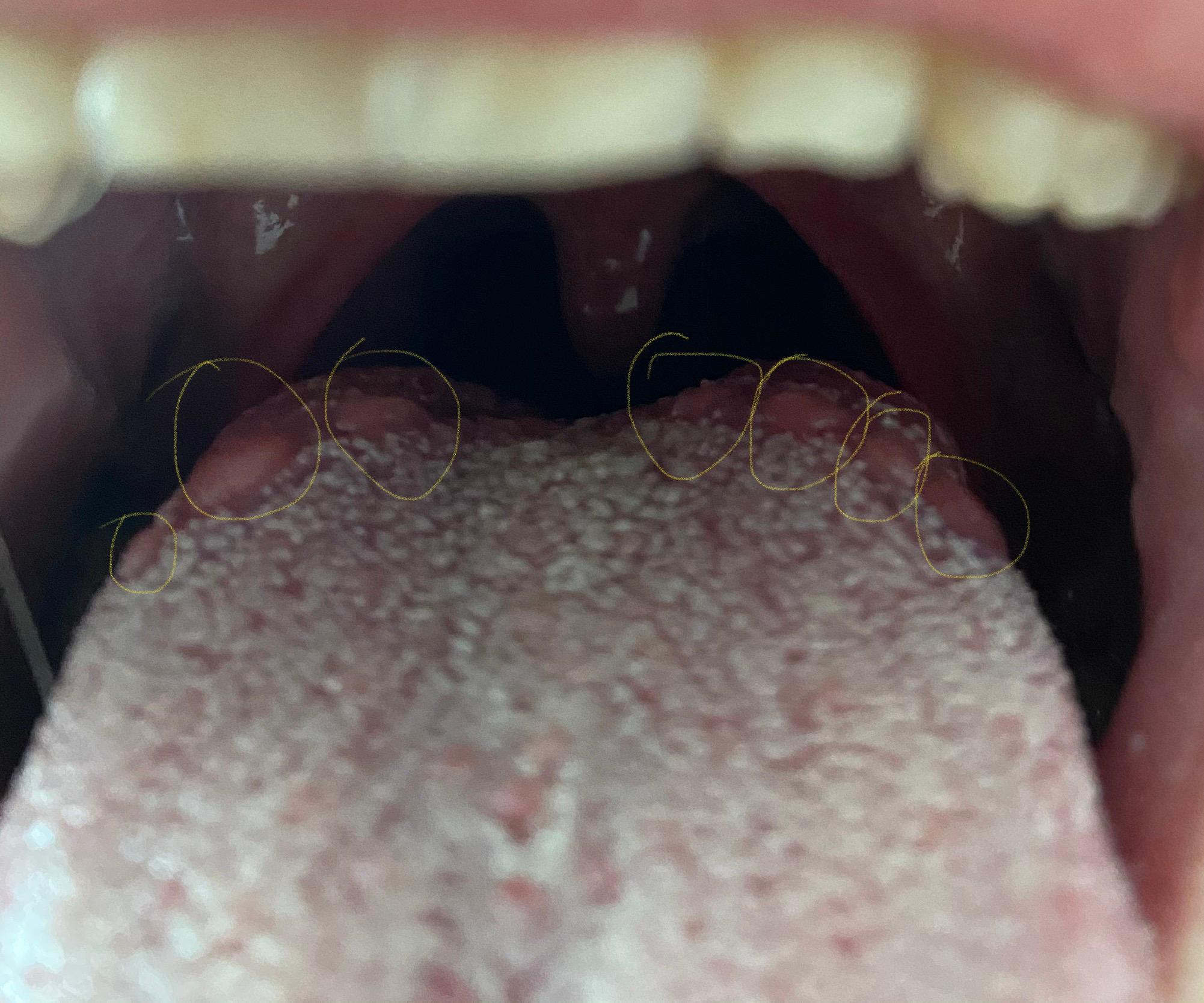Erhöhungen/Beulen auf Zunge? Pilz? (Gesundheit und Medizin, Gesundheit