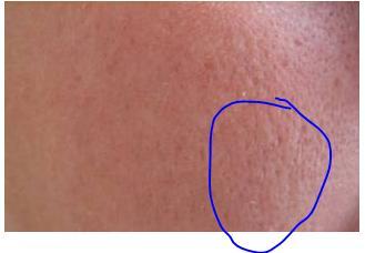 Erholt Sich Die Haut Wieder Pickel