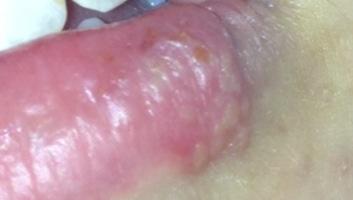 Erkältet seit 4 Tagen und jetzt eine Blase auf der Lippe.