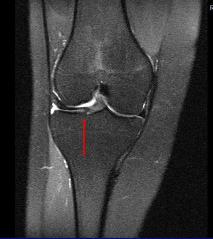 Erkennt Hier Irgendjemand Was Mrt Knie Rechts Medizin Arzt Schmerzen Erkennt Hier Irgendjemand Was Mrt Knie Rechts Medizin Arzt Schmerzen