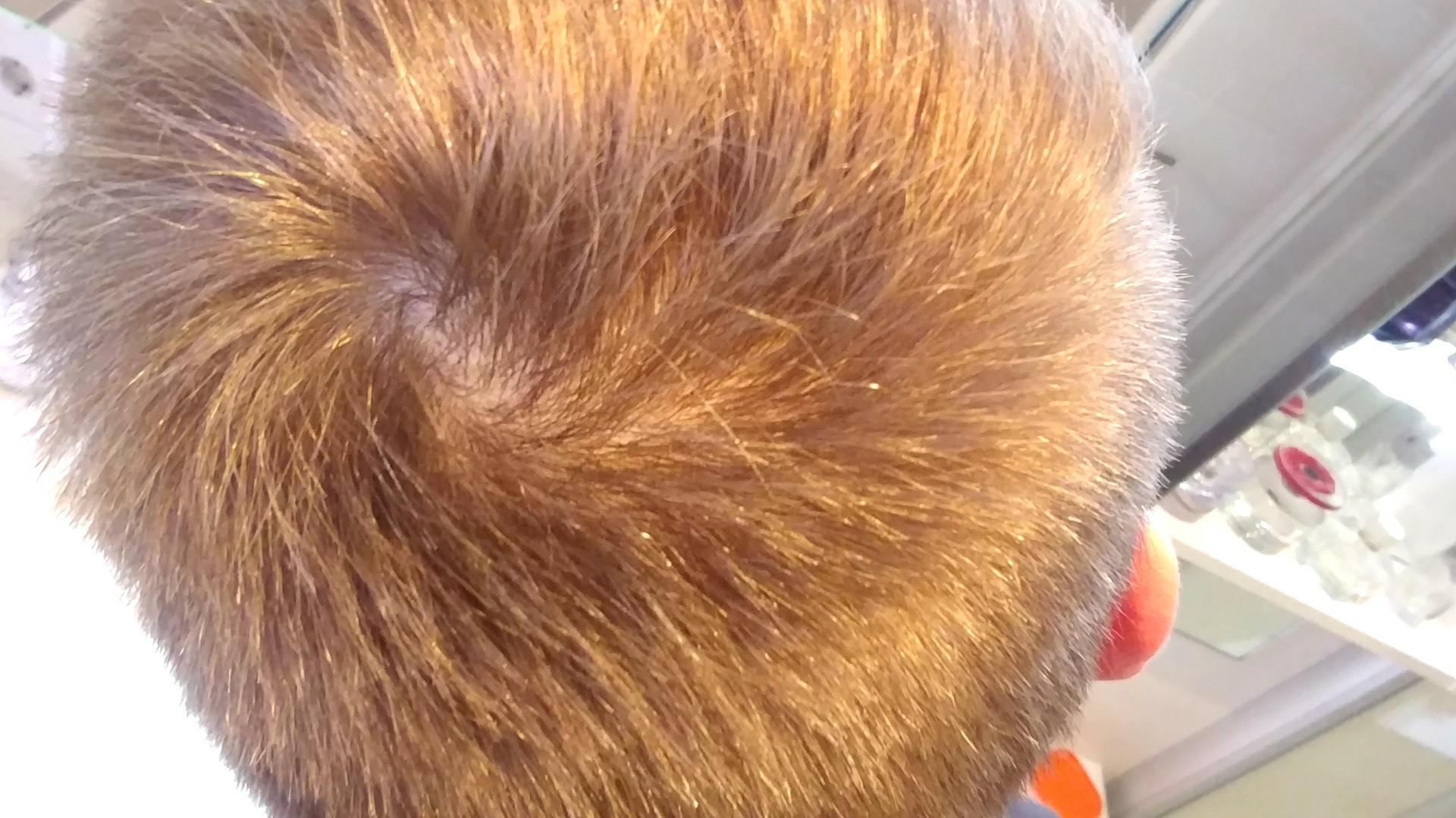 erste anzeichen fur haarausfall foto