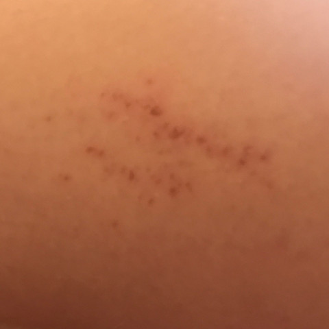 Es Juckt Mich Am Ganzen Korper Und Wenn Ich Kratze Kommt An Manchen Stellen Solche Flecken Siehe Bild Was Bedeutet Das Gesundheit Und Medizin Es Juckt Mich Am Ganzen Korper Und Wenn Ich Kratze Kommt An Manchen Stellen Solche Flecken Siehe Bild Was Bedeutet Das Gesundheit Und Medizin