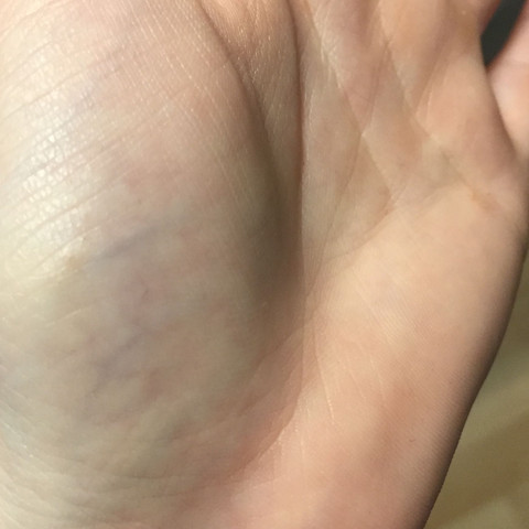 Handfläche, nicht so leicht erkennbar - (Gesundheit und Medizin, Pickel, Juckreiz)