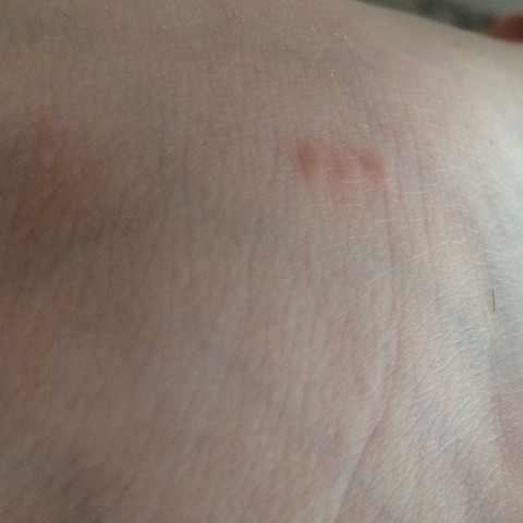 - (Stich, Biss, Wasistdas)