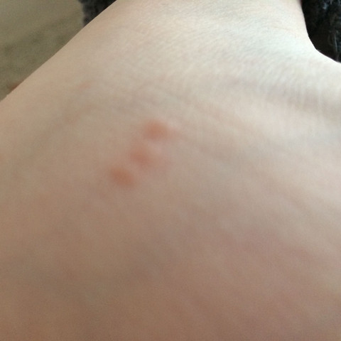 - (Stich, Biss, Wasistdas)