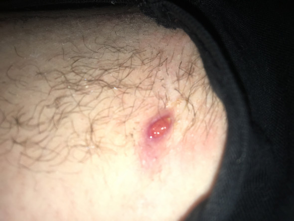 bukel dann war es ein pickel jezt