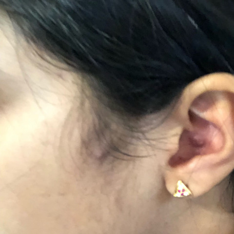 Etwas Braunes Im Ohr Gesundheit Pickel Narben
