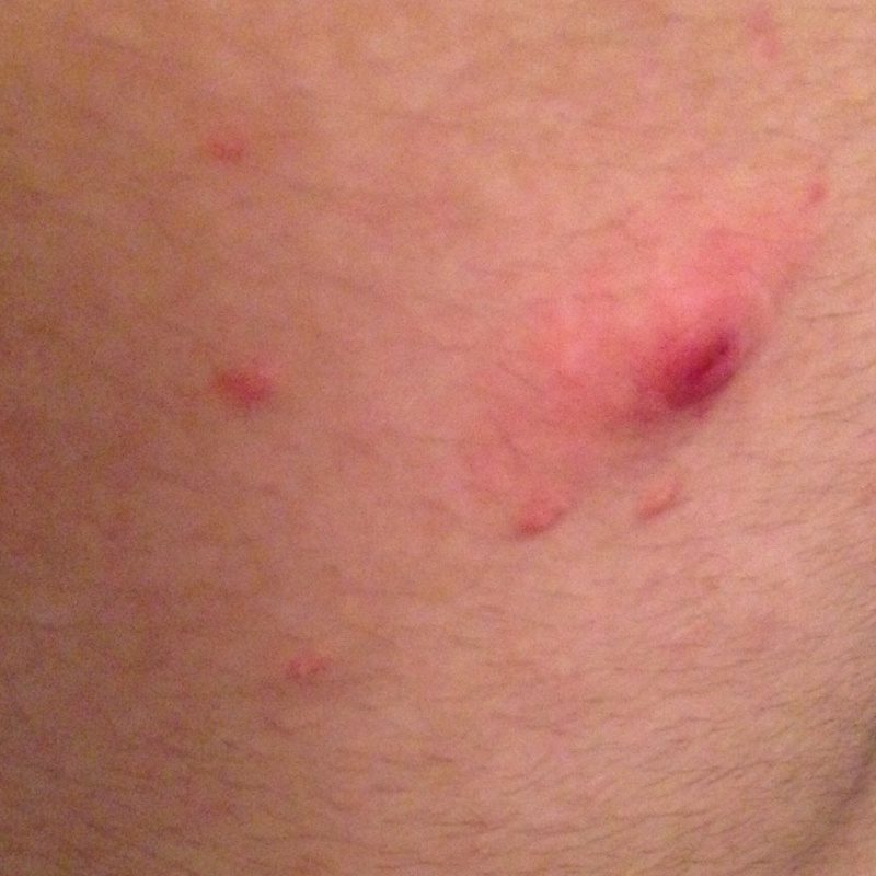 Etwas groÃ?es pickelähnliches Ding am Rücken (Pickel, Entzündung, Ã?hnlichkeit) pickel entzündung