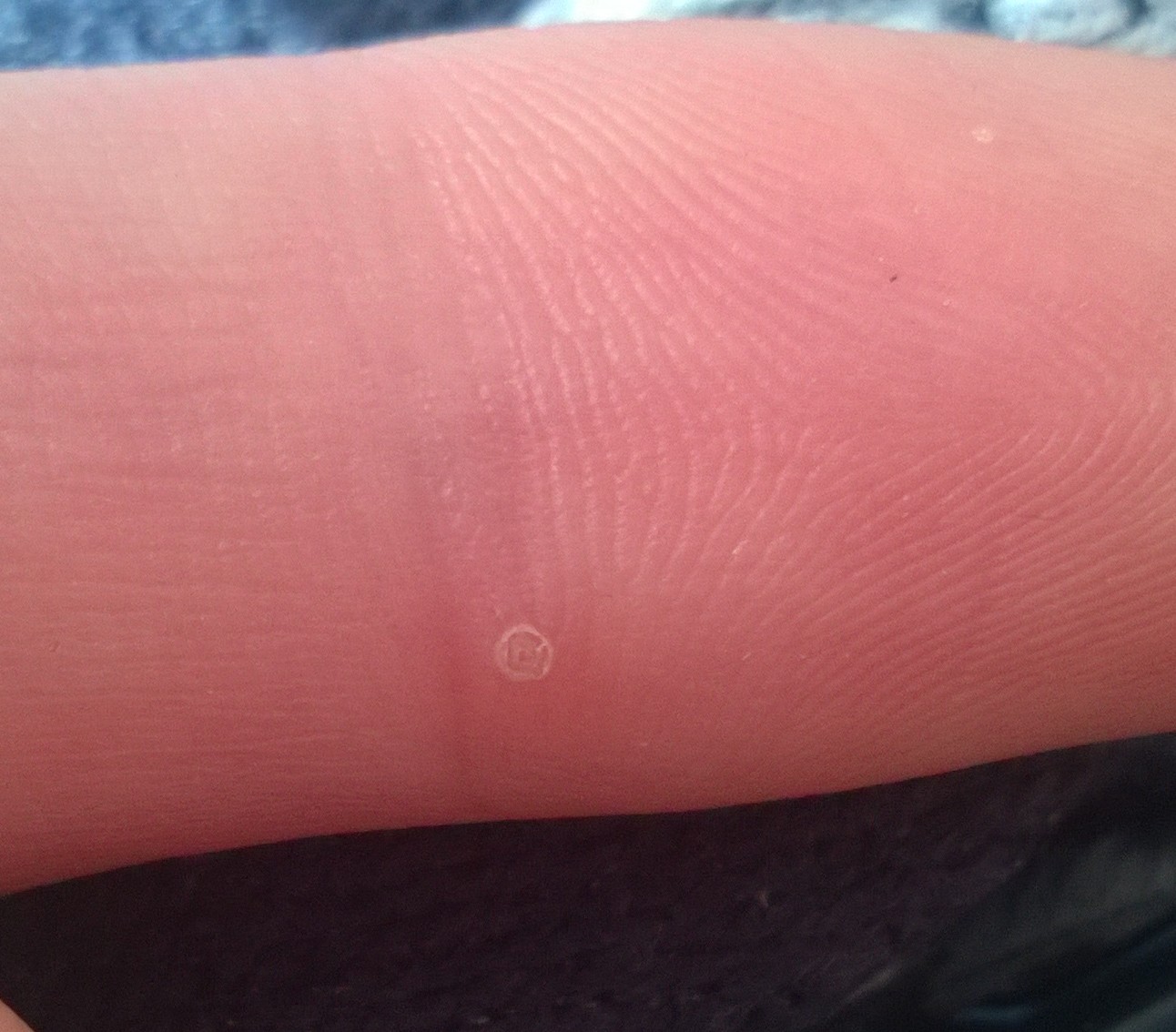 Etwas Harter Punkt Auf Finger Was Ist Das Punkte 