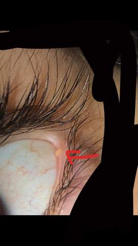 Etwas Komisches Am Auge Bild Gesundheit Und Medizin Gesundheit Augen Etwas Komisches Am Auge Bild Gesundheit Und Medizin Gesundheit Augen