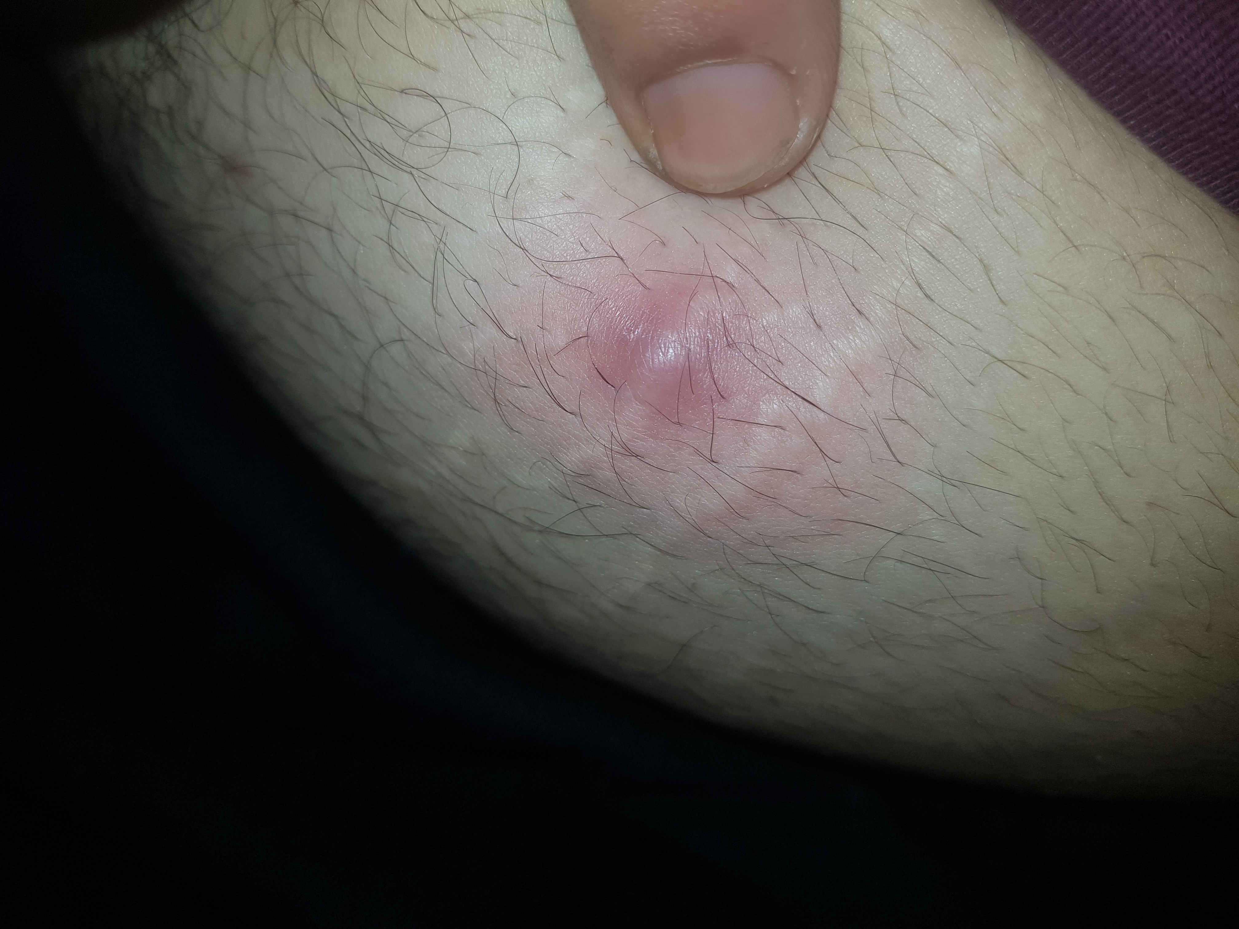 Etwas Komisches Am Bauch Oder Doch Nurn Pickel Gesundheit Und Medizin Haare Arzt Etwas Komisches Am Bauch Oder Doch Nurn Pickel Gesundheit Und Medizin Haare Arzt