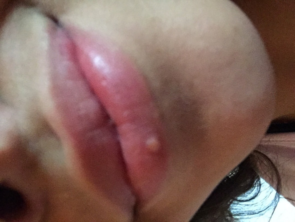 - (Entzündung, Lippe)
