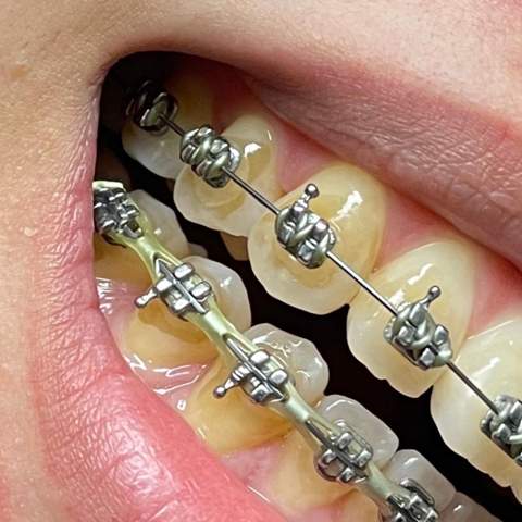 Extrem Braune Zähne und Karies durch die Zahnspange?