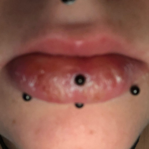 Pierced, Herpes, extrem, Schwellung, Schmerz  - (Gesundheit und Medizin, Lippe, Schwellung)