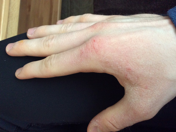 Extrem Rissige Trockene Sprode Hande Korper Diat