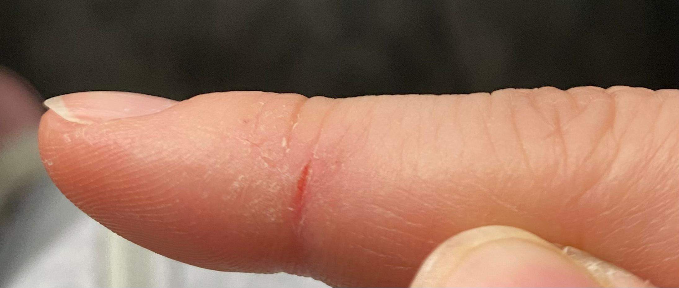 Extrem trocken Finger platzen auf? (Gesundheit und Medizin, Gesundheit