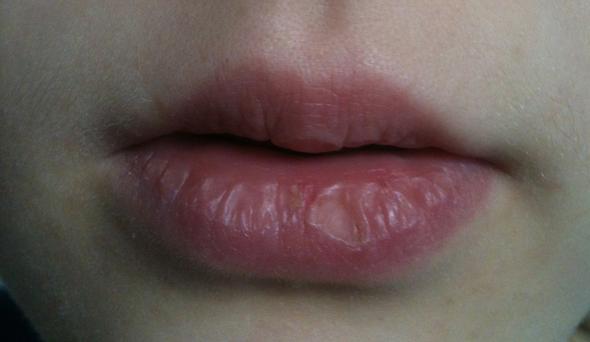 Trocken Lippen