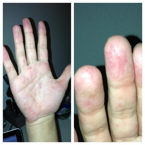 Extrem Trockene Hande Rote Punkte Rissige Haut Siehe Bild Arzt Hautpflege Trocken