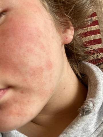 Extrem Trockene Haut In Unteren Gesicht Gesundheit Und Medizin Beauty Extrem Trockene Haut In Unteren Gesicht Gesundheit Und Medizin Beauty