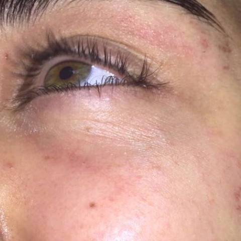 Extrem Trockene Haut Was Kann Das Sein Augen Neurodermitis