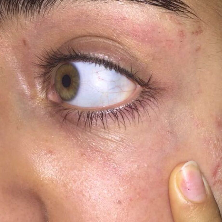 Extrem trockene Haut, was kann das sein? (Augen, Neurodermitis) Extrem trockene Haut, was kann das sein? (Augen, Neurodermitis)