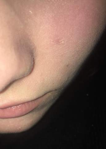 Extrem Trockene Haut Was Kann Ich Tun Gesundheit Und Medizin Hautprobleme Extrem Trockene Haut Was Kann Ich Tun Gesundheit Und Medizin Hautprobleme