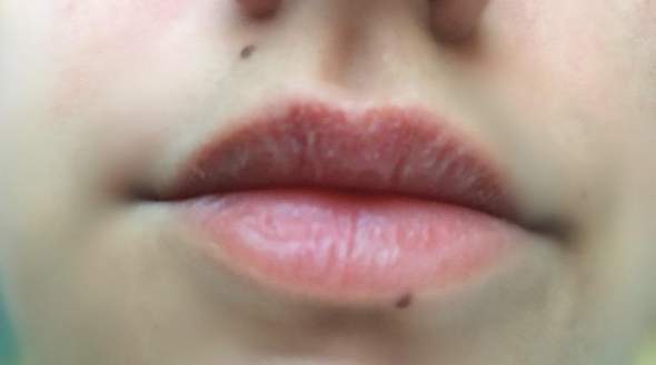 Rand um lippen roter Dermatologie: Was
