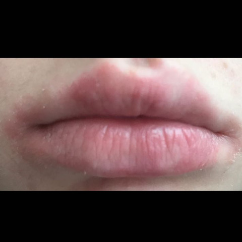 Extrem Trockene Rote Lippen Und Eingerissene Mundwinkel Was Tun Gesundheit Und Medizin Arzt Hautpflege