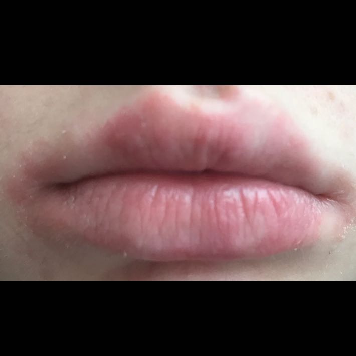 Extrem Trockene Lippen