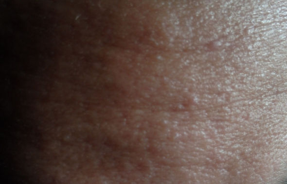Extrem Trockene Gesichtshaut Extrem Trockene Gesichtshaut