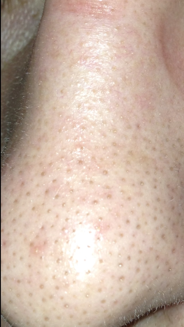 Download Pickel Unter Der Haut Was Tun Pictures