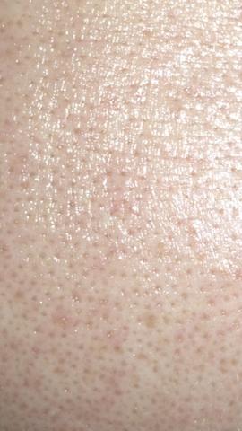 Stirn - (Haut, Hautpflege, unreine Haut)