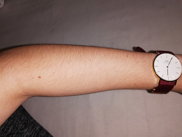 Extreme Armbehaarung Loswerden Entfernen