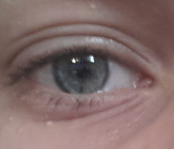 Bild - (Augenringe, extrem)