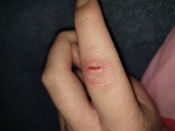 Extreme Risse Wegen Trockener Haut Am Finger Gefahrlich Gesundheit Und Medizin Hausmittel Heilung Extreme Risse Wegen Trockener Haut Am Finger Gefahrlich Gesundheit Und Medizin Hausmittel Heilung