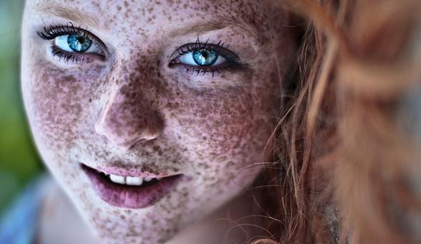 Ich Habe Extreme Sommersprossen Ich Leide Sehr Darunter Was Kann Ich Dagegen Tun Haut Ich Habe Extreme Sommersprossen Ich Leide Sehr Darunter Was Kann Ich Dagegen Tun Haut