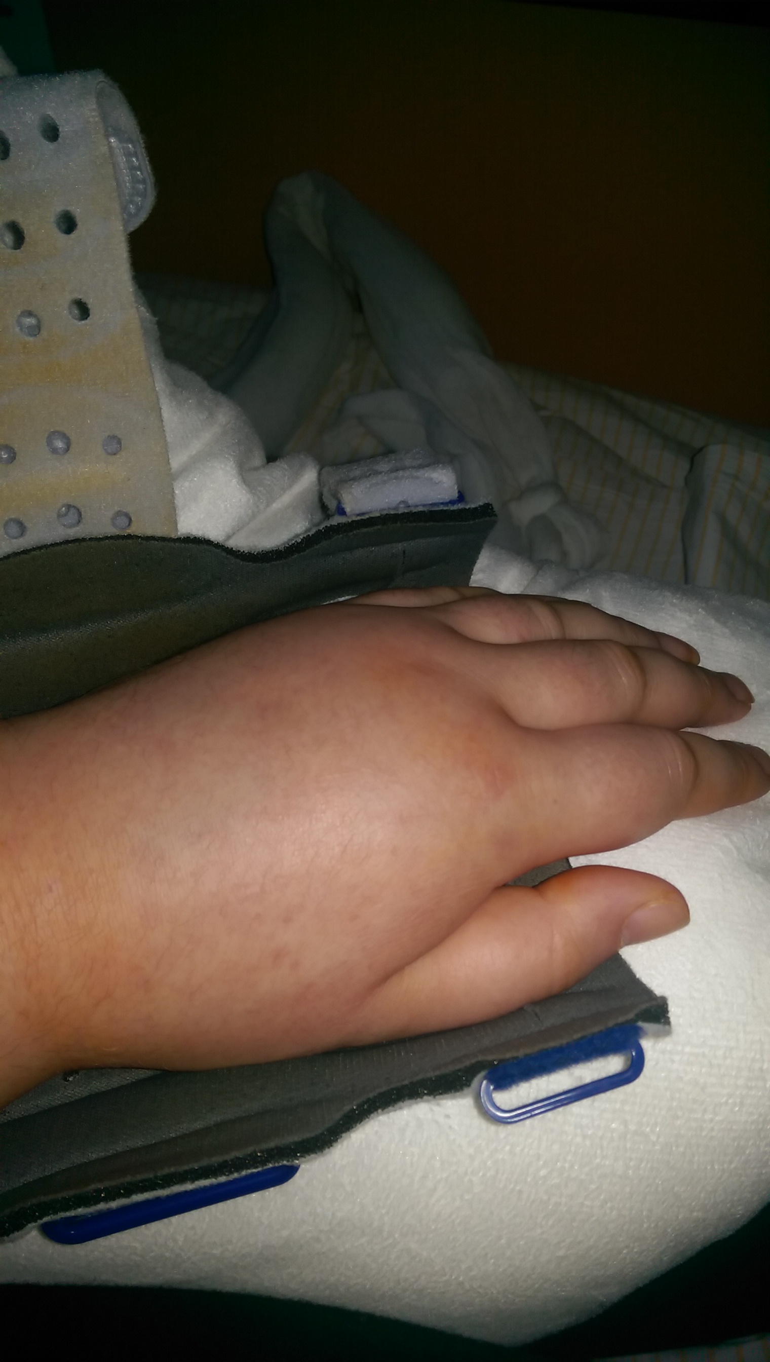 Extreme Wassereinlagerung Bei Gebrochenem Arm Wassereinlagerungen Armbruch Extreme Wassereinlagerung Bei Gebrochenem Arm Wassereinlagerungen Armbruch