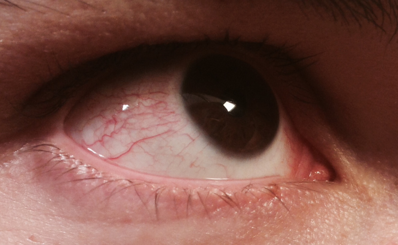 Extremer Fall von trockenen Augen?! (Rote Augen, trockene Augen, Augen brennen)1326 x 818