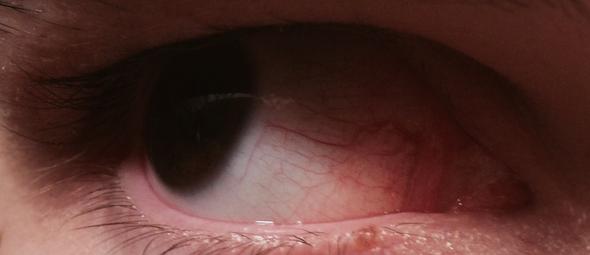 Rote (geplatzte?) Adern in den Augen... - (Augen, Rote Augen, trockene Augen)