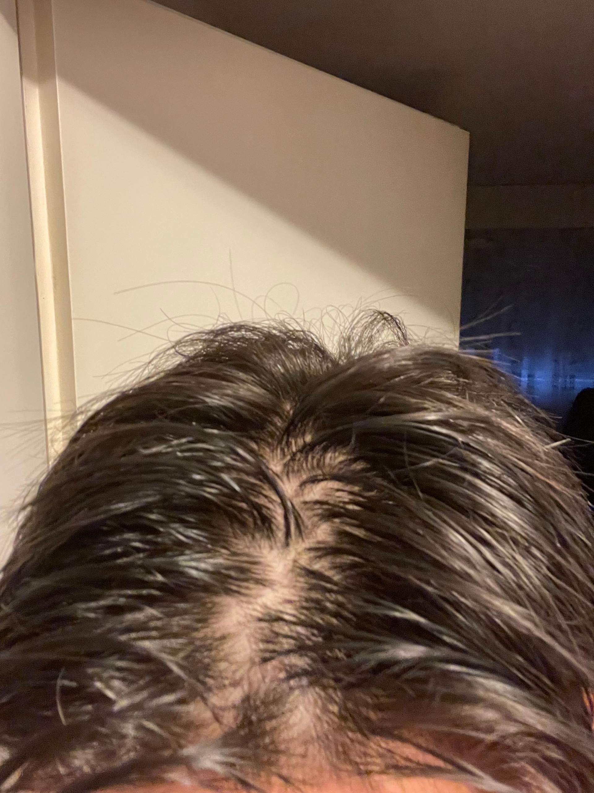 Extremer Haarausfall? (Haare)