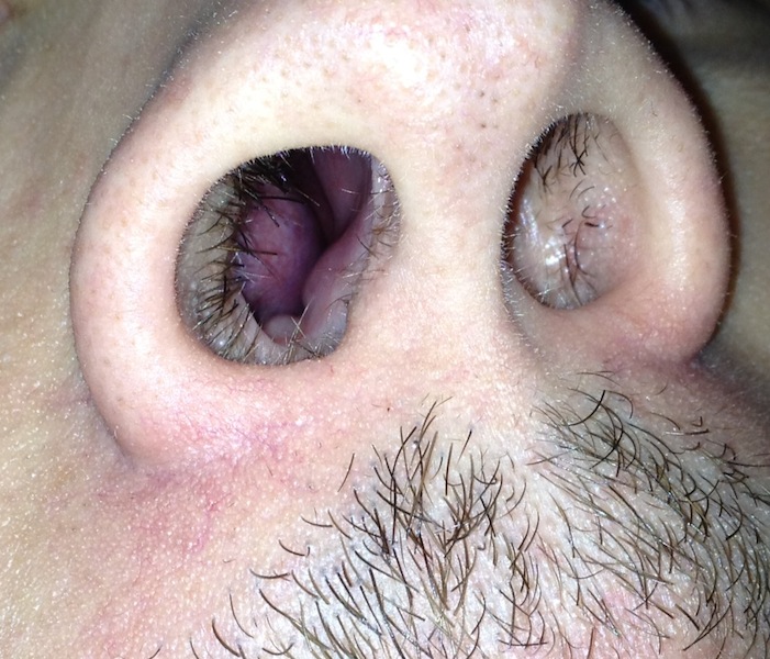 Woher kommt dieses extreme Druckgefühl auf/ in der Nase? (Gesundheit