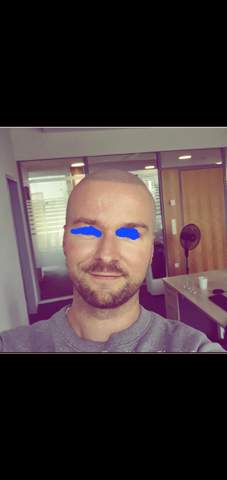 Fällt euch an meiner Frisur/Glatze etwas ungewöhnliches auf (siehe Bild)?