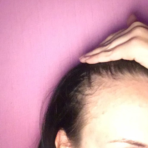 Fallen Bald Meine Ganzen Haare Aus Gesundheit Tipps Haarausfall Fallen Bald Meine Ganzen Haare Aus Gesundheit Tipps Haarausfall