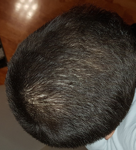 fallen mir die haare aus gesundheit