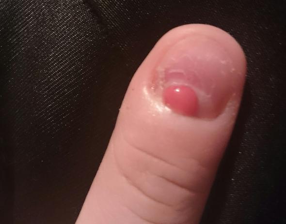 Fehlendes Stuck Im Nagel Entzundet Wie Behandeln Entzundung Fingernagel