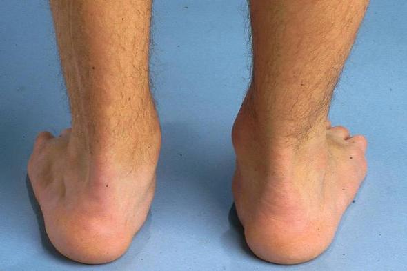 also das sind NICHT meine füße, das ist ein bild aus dem internet,  - (Arzt, Füße, Fehlstellung)