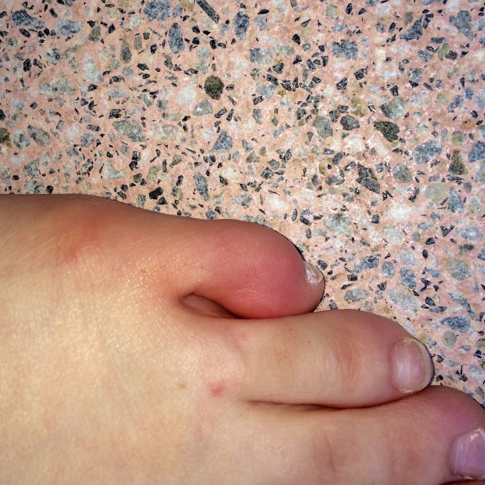 Fehlstellung der kleinen Zehe... wie kann man behandeln? (Medizin, Arzt, Schmerzen) Fehlstellung der kleinen Zehe... wie kann man behandeln? (Medizin, Arzt, Schmerzen)